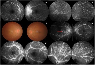Collapsin response mediator protein 5-associated optic neuropathy: clinical characteristics, radiologic clues, and outcomes